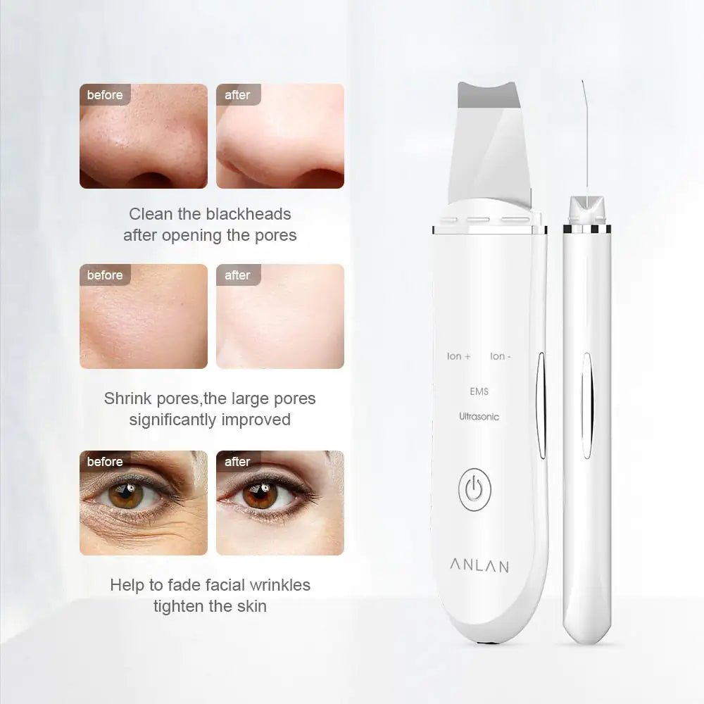 Ultrasonic Skin Scrubber - LegacyAxis